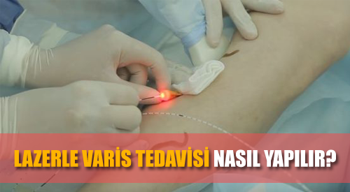 lazerle varis tedavisi