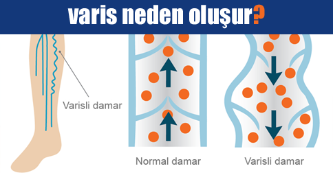 varis neden oluşur