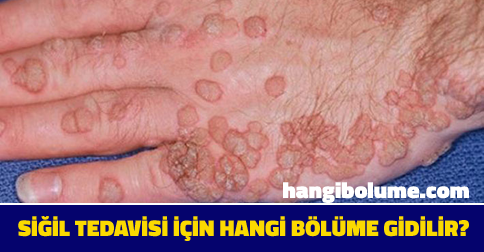 Siğil İçin Hangi Bölüme Gidilir?