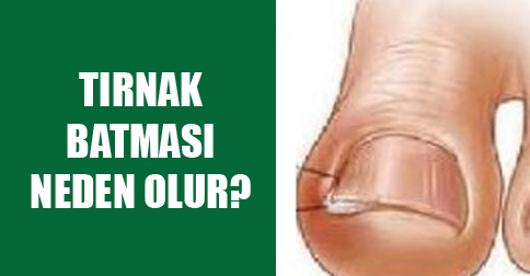 Tırnak Batmasına Hangi Doktor Bakar?