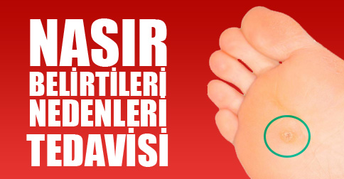 nasır tedavisi